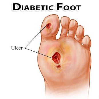 Schedule Your Diabetic Foot Exam